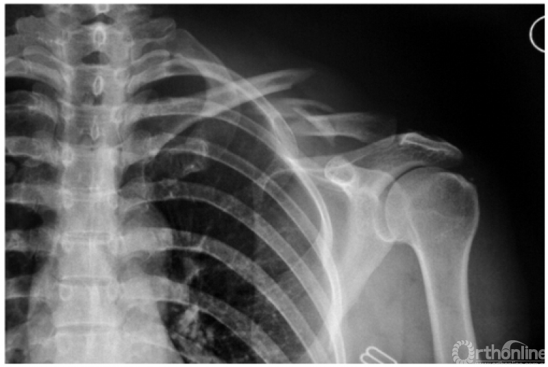 锁骨中段骨折锁骨是桥架于肩胛骨与躯干之间唯一的上肢连接躯干的