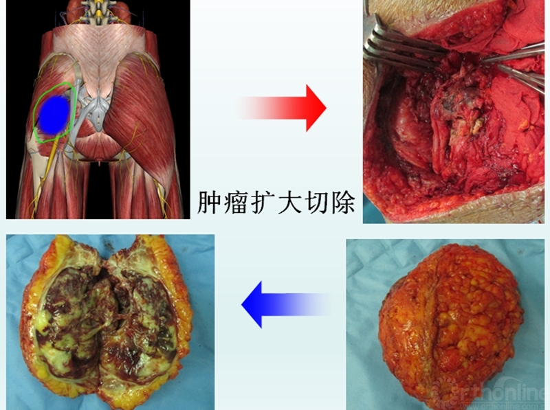 肿瘤扩大解除