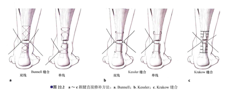 收藏跟腱断裂诊疗策略