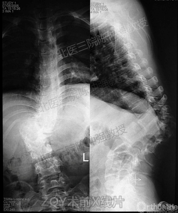 3ZQY术前X线片.jpg