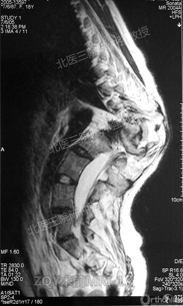 5ZQY术前MRI-1.jpg