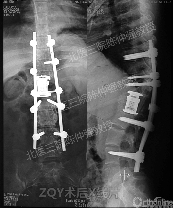 9ZQY术后X线片.jpg