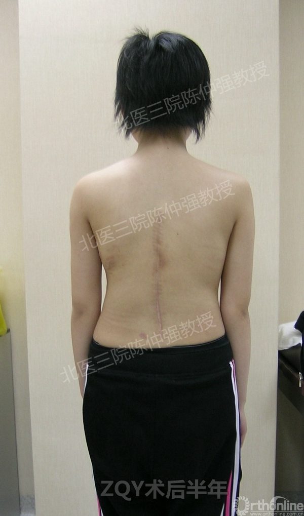 11ZQY术后半年.jpg