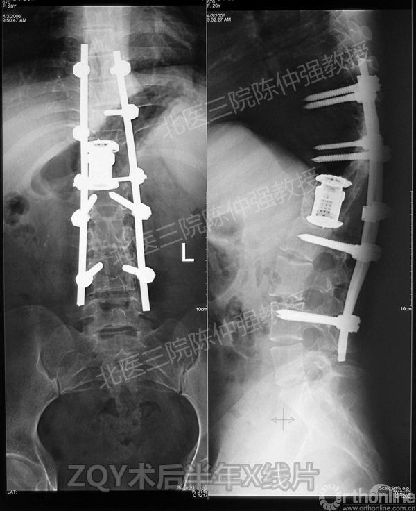 12ZQY术后半年X线片.jpg