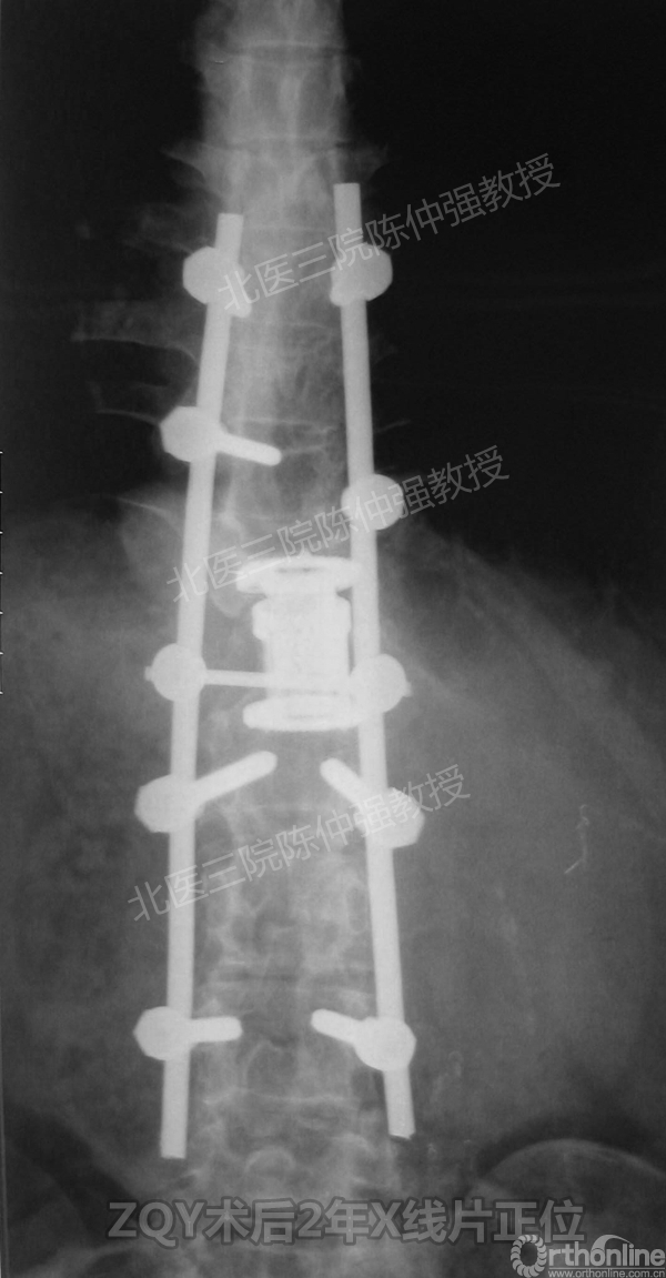 16ZQY术后2年X线片正位.jpg