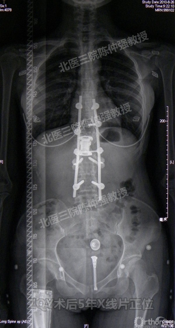 20ZQY术后5年X线片正位.jpg