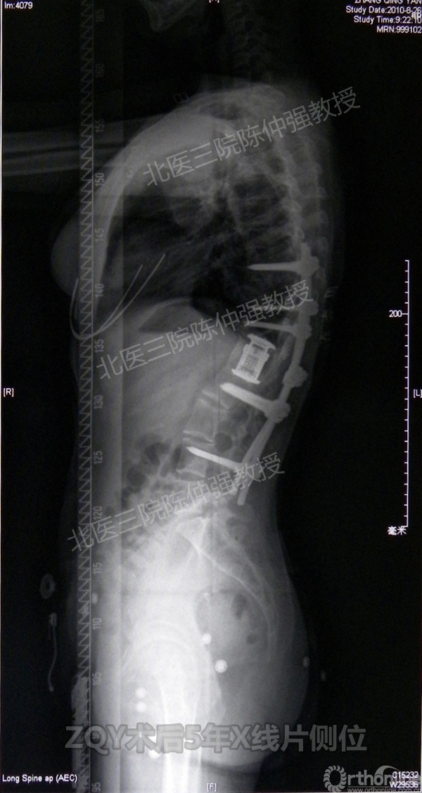 21ZQY术后5年X线片侧位.jpg