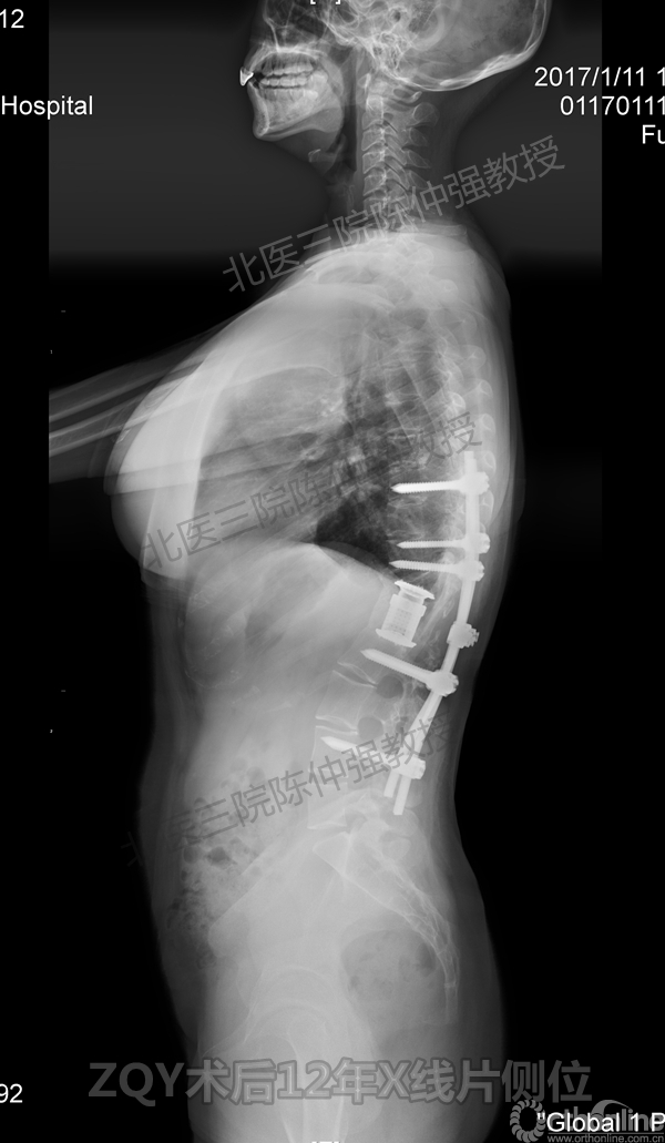 24ZQY术后12年X线片侧位.jpg