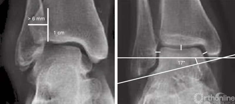 實用經驗這才是踝關節骨折的最佳方案