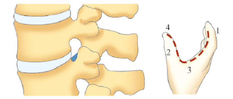 突中部至基底部;2:前緣,下位椎體後壁;3:下界,下位椎體椎弓根上切跡;4