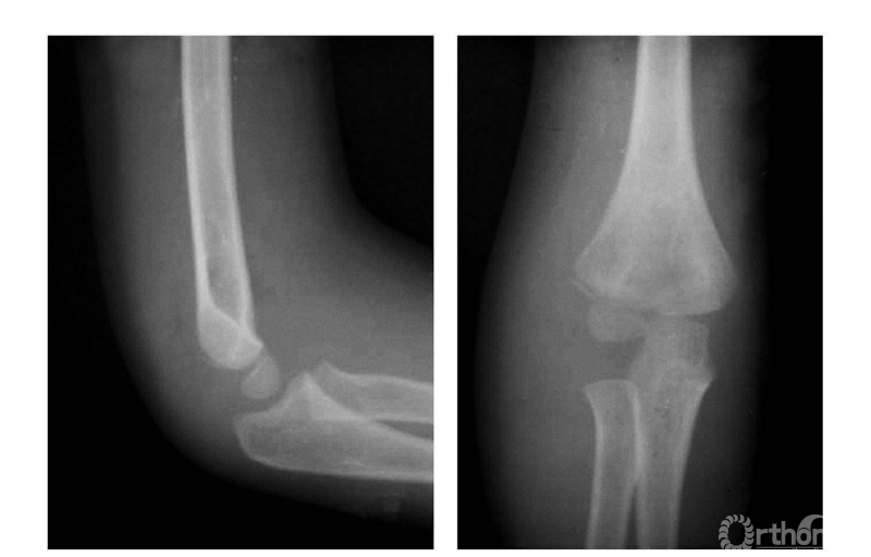 骨科常见疾病x线解析之肱骨远端全骨骺分离 
