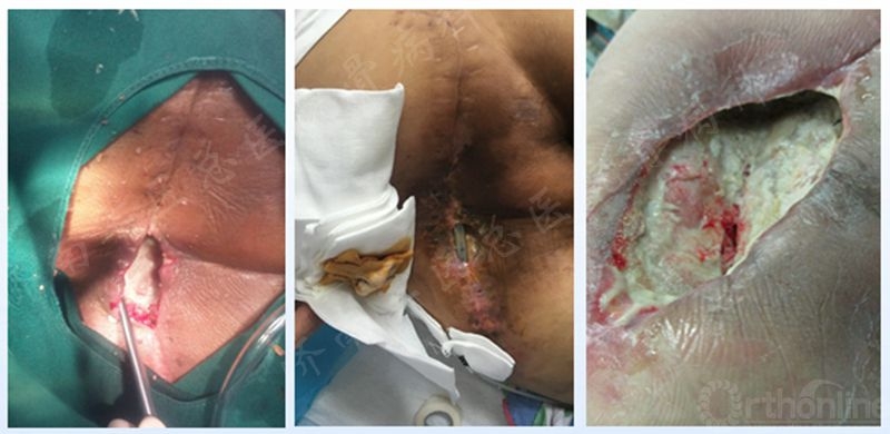 术后创面感染清创vsd吸引大腿前侧皮瓣覆盖的半骨盆离断术总 结软组织