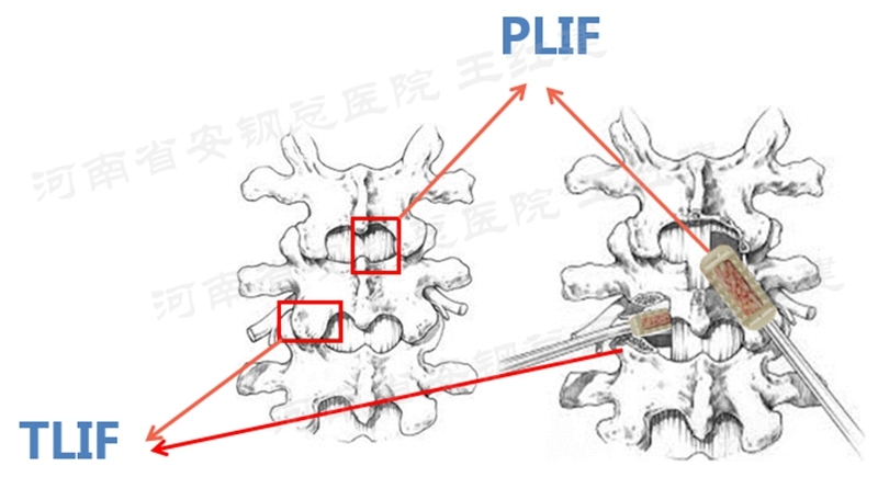 tlif手术终板处理非常重要,关系到椎间融合率,椎间融合器需要选足够