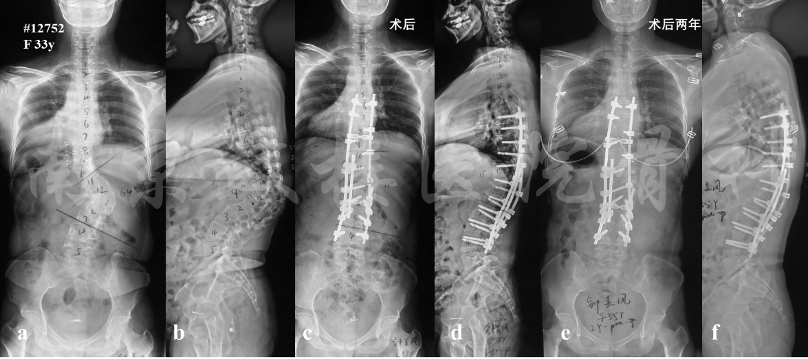 x片示t12楔形變,胸腰段角狀側後凸畸形(a, b),行t12全脊椎切除術(t12