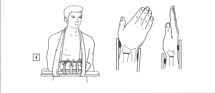 前臂夹板固定的示意图图片