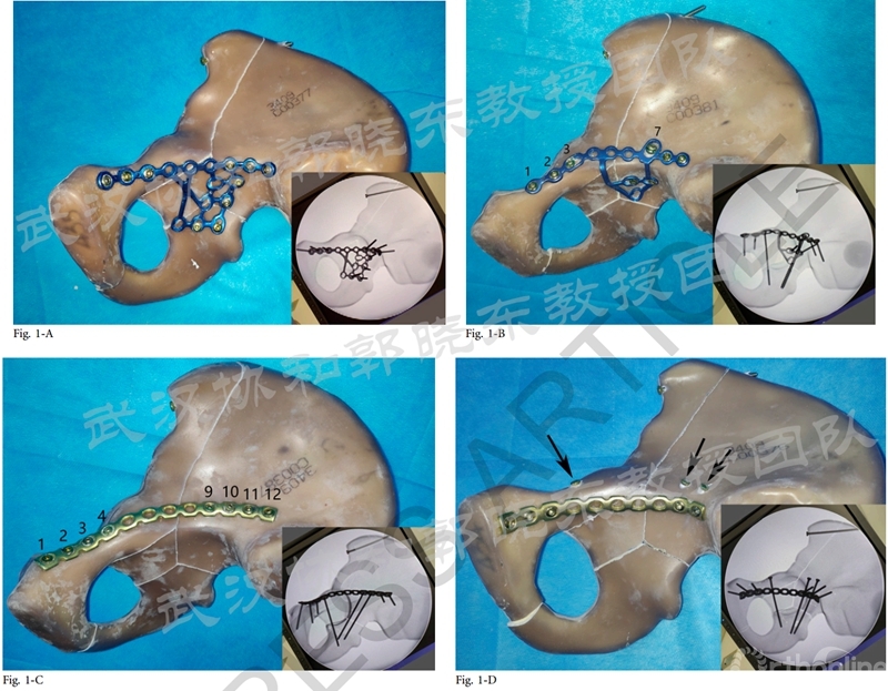 髋臼骨折钢板图片