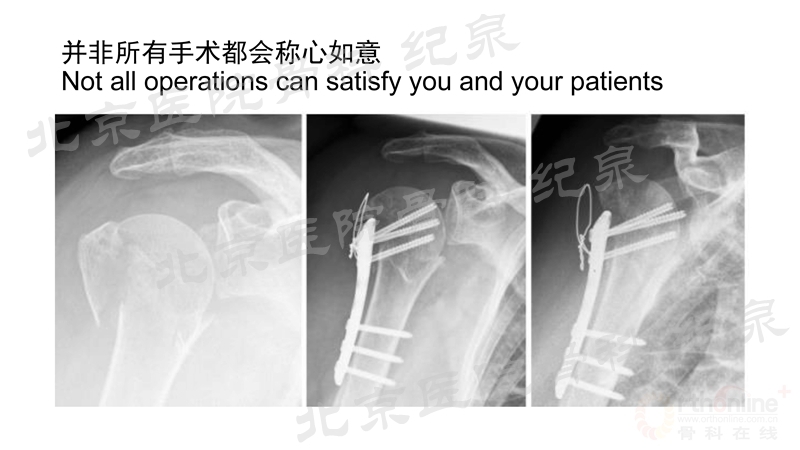 肱骨近端骨折微创OR传统中文版_页面_07_副本.jpg