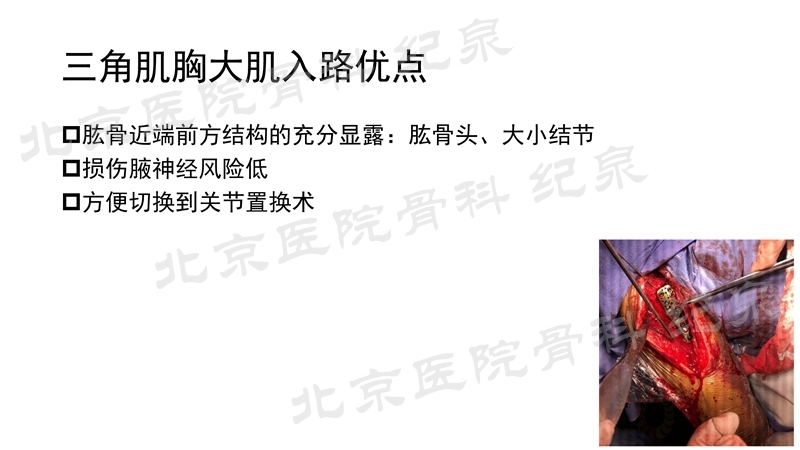 肱骨近端骨折微创OR传统中文版_页面_17_副本.jpg