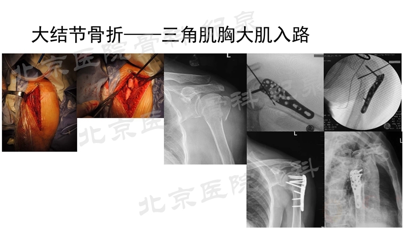 肱骨近端骨折微创OR传统中文版_页面_19_副本.jpg