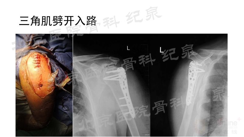肱骨近端骨折微创OR传统中文版_页面_28_副本.jpg