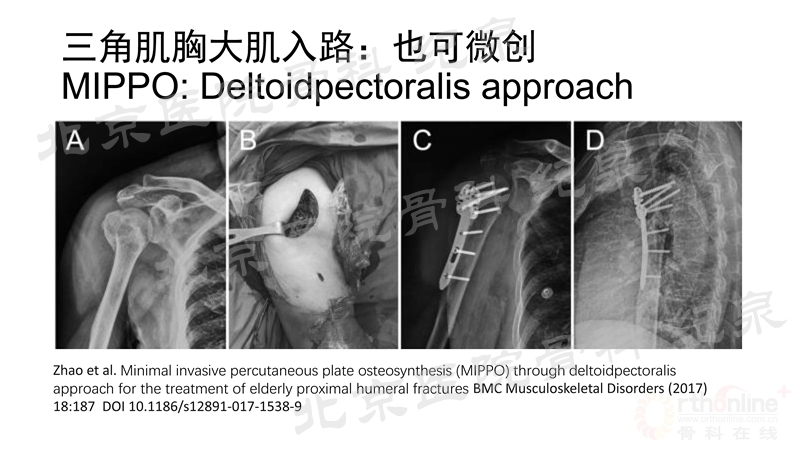 肱骨近端骨折微创OR传统中文版_页面_29_副本.jpg