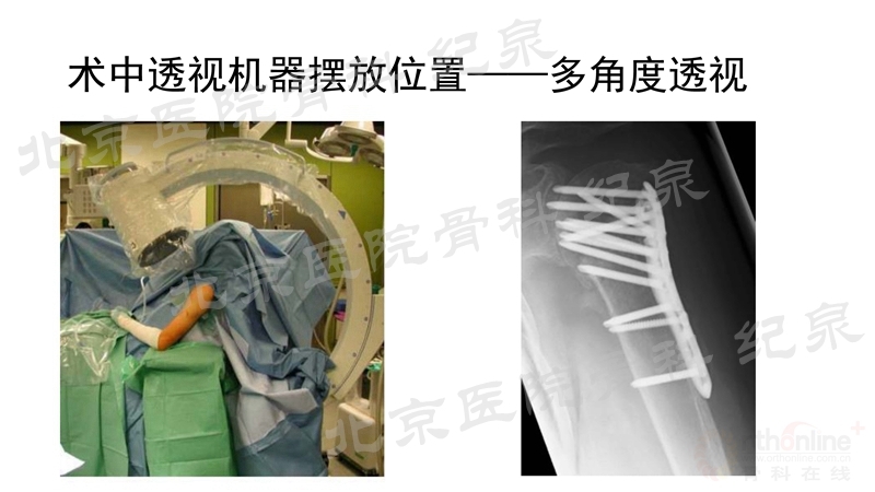 肱骨近端骨折微创OR传统中文版_页面_30_副本.jpg