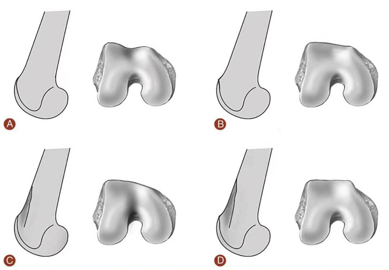 图14 股骨滑车发育异常分型 a型:交叉征;b型:交叉征 突起征;c型:交叉