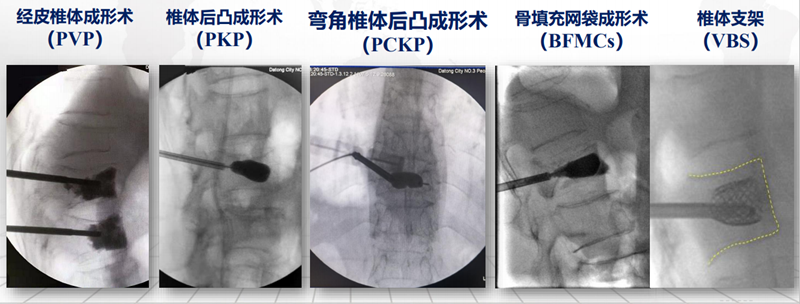 临床经验|弯角球囊椎体后凸成形术（PCKP）临床应用初体会| 骨科在线